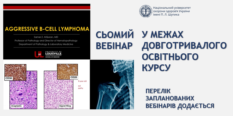 Міжнародна освітня естафета: 7-й вебінар про діагностику агресивних лімфом
